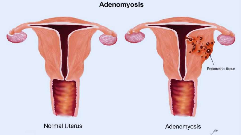 Adenomyosis - Awful Period Problems